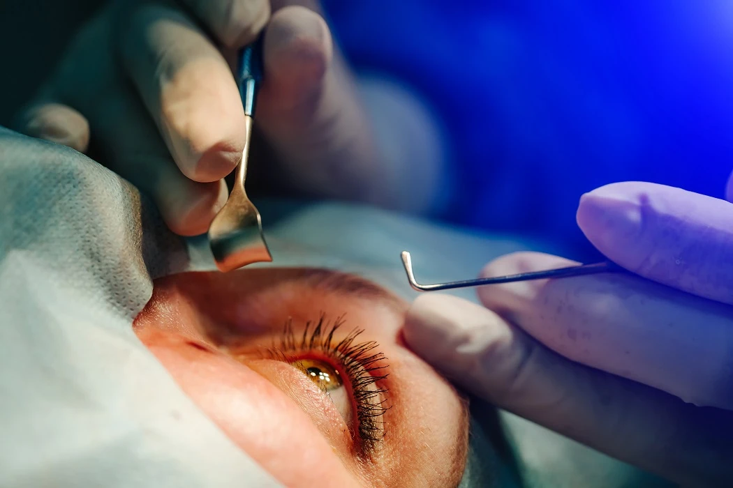Cataract Surgery
